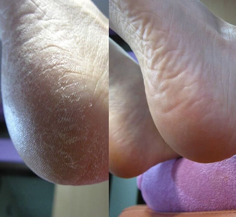 Photo of the heel of the foot before and after using Zenidol cream