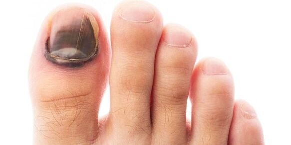 black toenail as a symptom of a fungus
