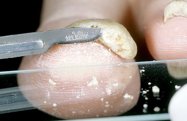 scratching fingernails to diagnose fungus