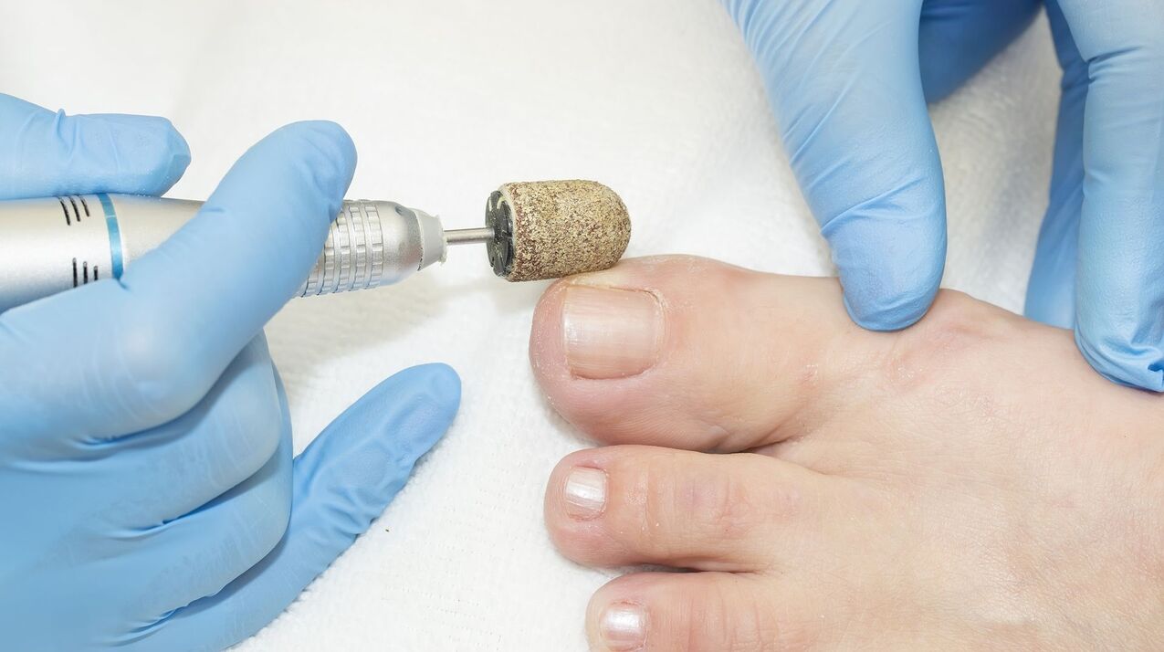 hardware treatment of fungus on the nails