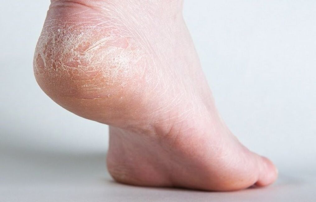 skin fungus on the leg how to treat