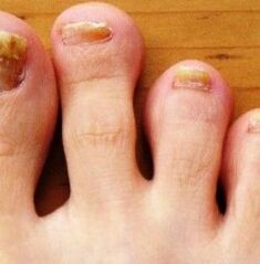 The foot of the NOG