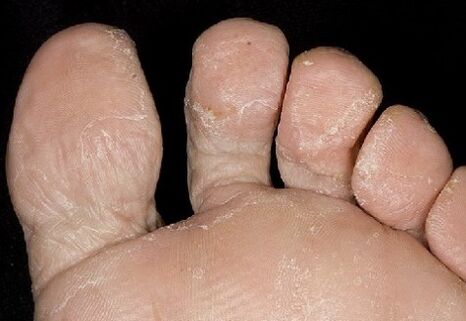 The initial step of the fungus, between the fingers