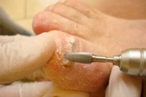 Mechanical cut of the nail plate
