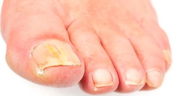 Nail mushroom