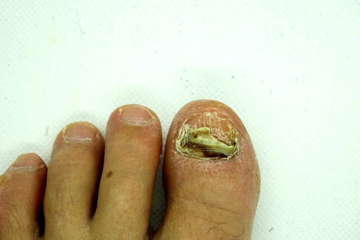 Finger nail fungus - heavy scene