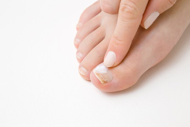 Finger treatment with mushroom ointment