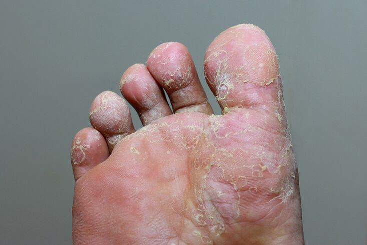 Severous stage of fingertips