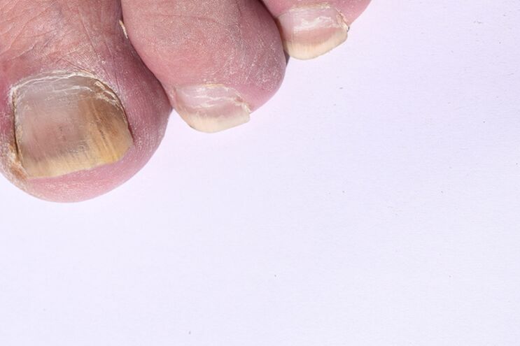 The initial stadium of nail mycosis on the legs