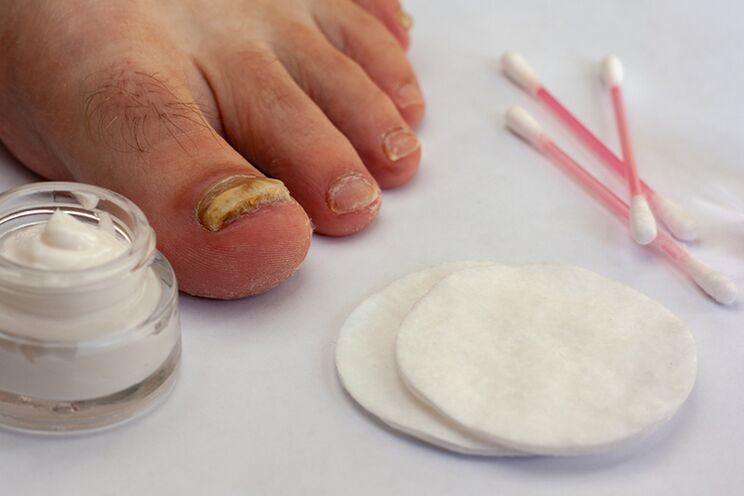 Treatment of fungus fingers with mushroom cream