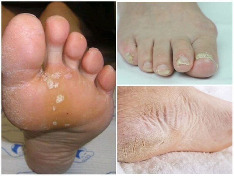 Mycosis symptoms