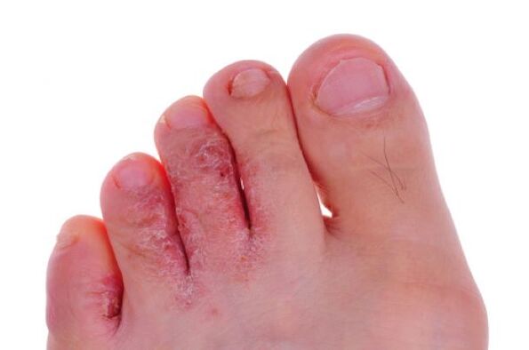 fungal toe disease