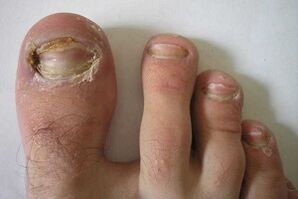 damage to toenail plates due to fungal infection
