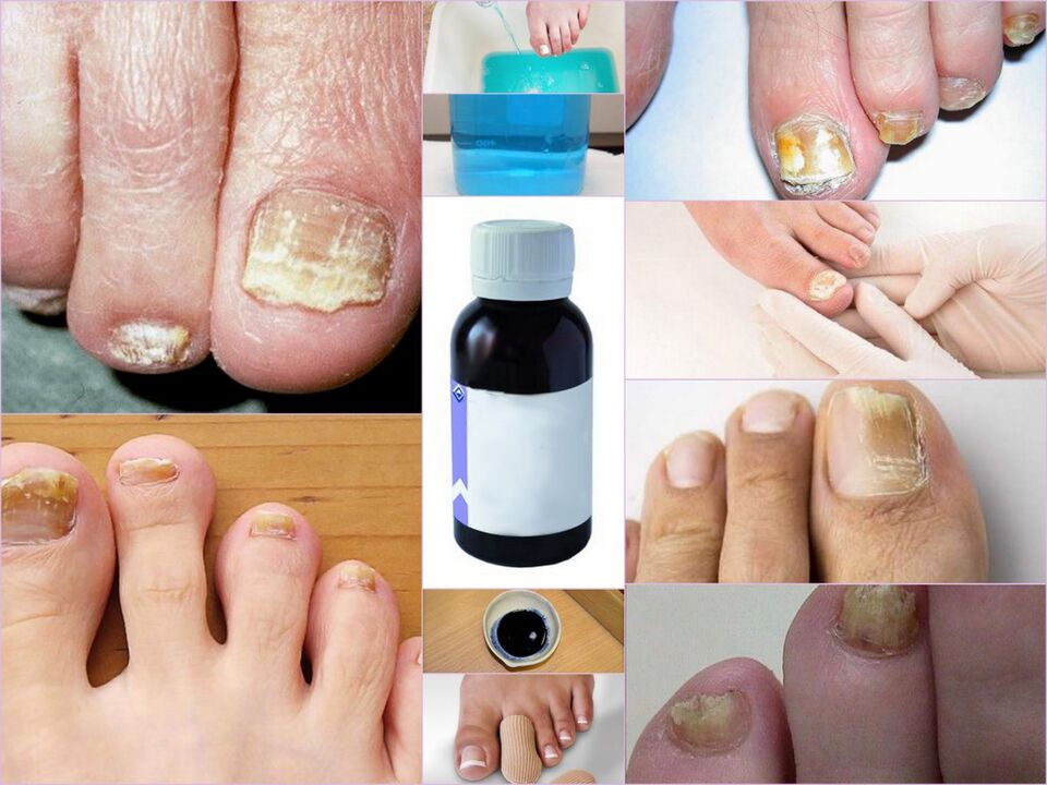 medications for toenail fungus