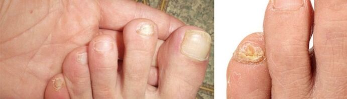 photo of manifestations of fungus on the toenails