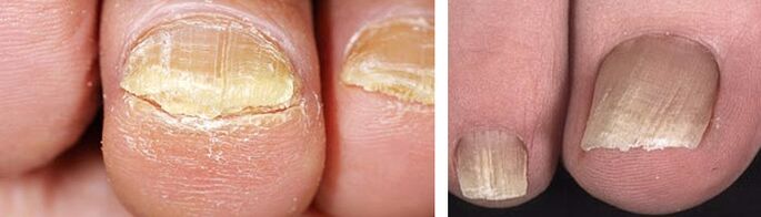 nail damage with fungal infection