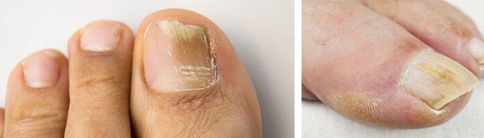 photo of fungal infection on the nail of the big toe