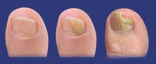 stages of fungus development on the toenails