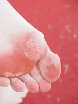 symptoms of yeast infection of the feet